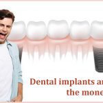 Read more about the article Dental Implants are Worth the Money Spent