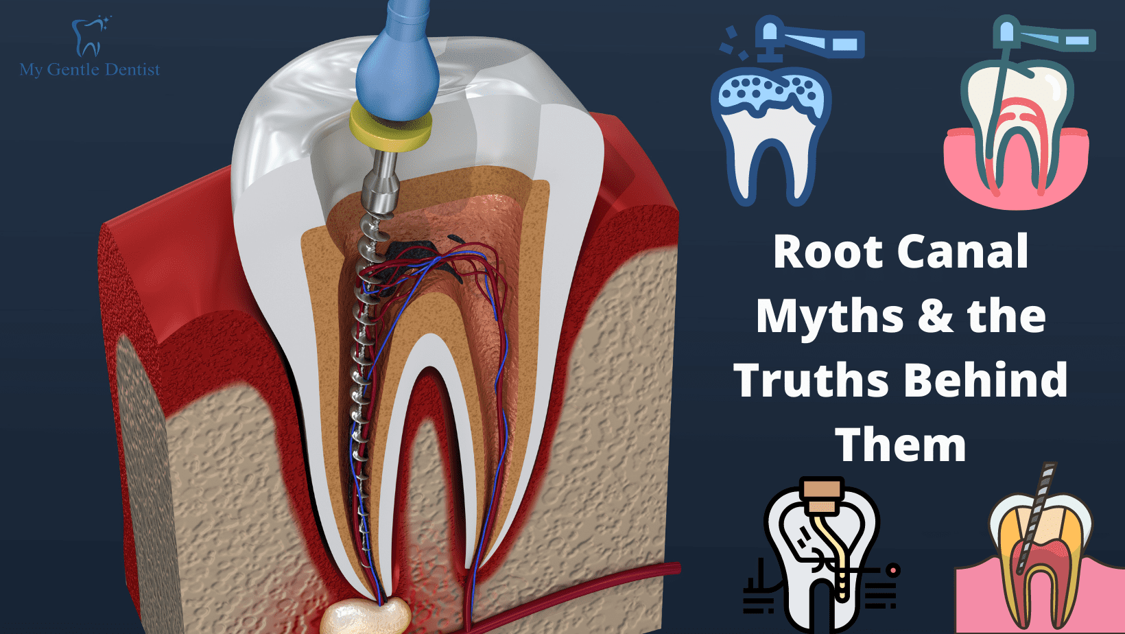 You are currently viewing 7 Root Canal Myths and the Truths Behind Them