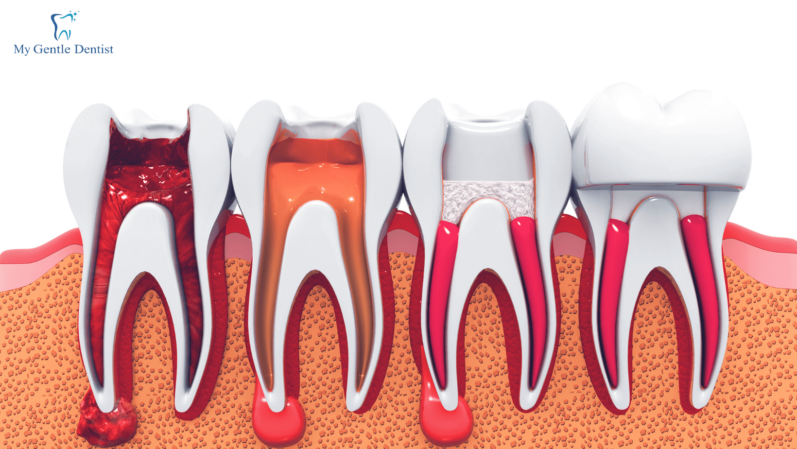 Root Canal Cost