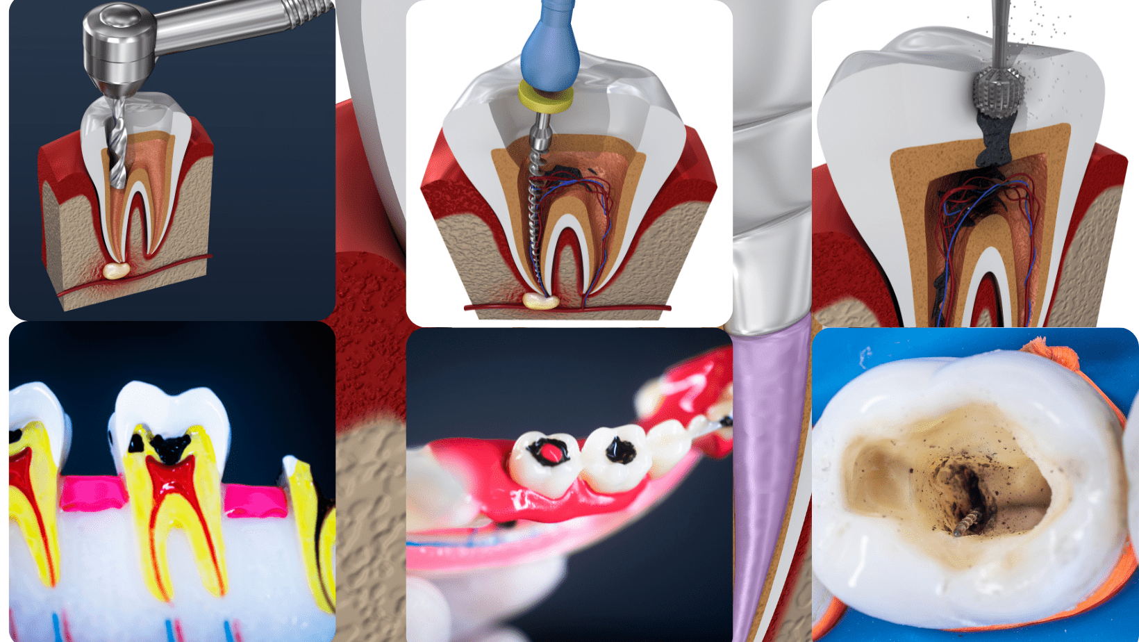  Root Canal Treatment Brisbane