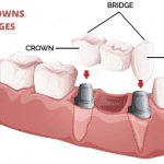 Read more about the article What are Dental Crowns and Bridges?
