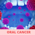 Read more about the article Oral Cancer: The Symptoms You Need to Know, and How to Prevent It