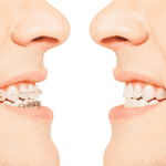 Read more about the article Straight Teeth Aren’t Just For A Pretty Smile: Braces’ Medical Benefits And How They Can Help You