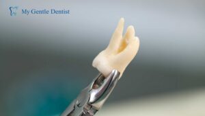 Read more about the article Affordable Wisdom Tooth Removal by Gentle Dentist in Brookside and Aranahills