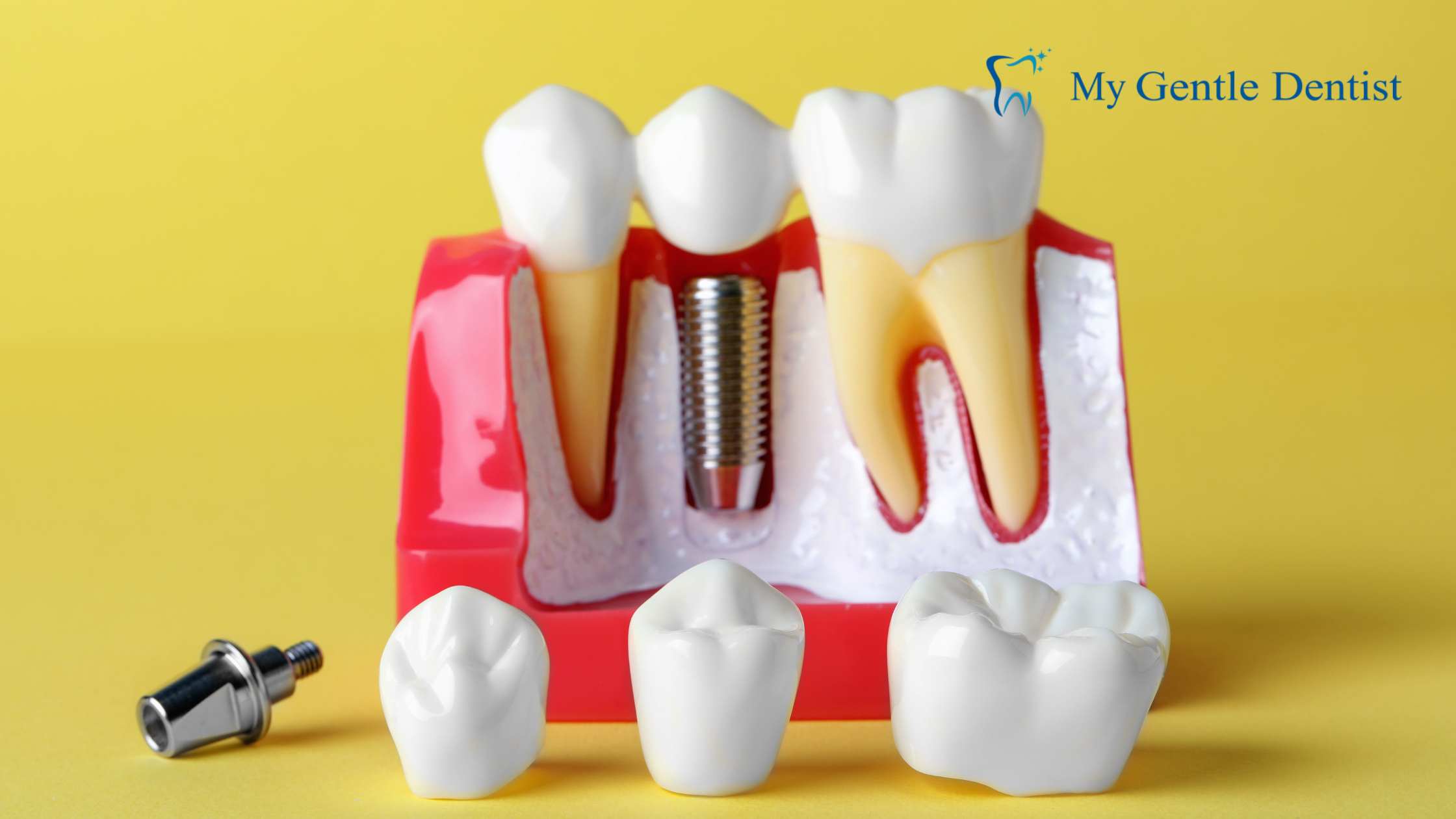 You are currently viewing Why Choose Dental Implants Near Me for a Permanent Smile Solution?