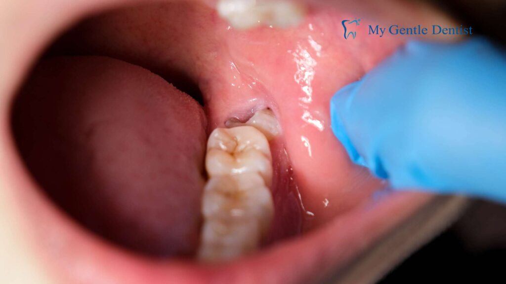 Wisdom Tooth Pain